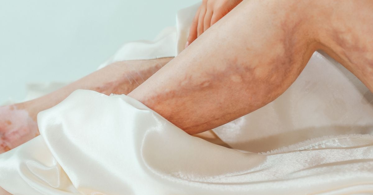 Wenn ein Bein plötzlich anschwillt: Ursachen verstehen und richtig abklären